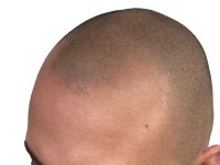 What are the Benefits of the Scalp Micro Pigmentation Treatment?