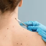 What to Anticipate from Professional Cosmetic Skin Tag Removal Treatments